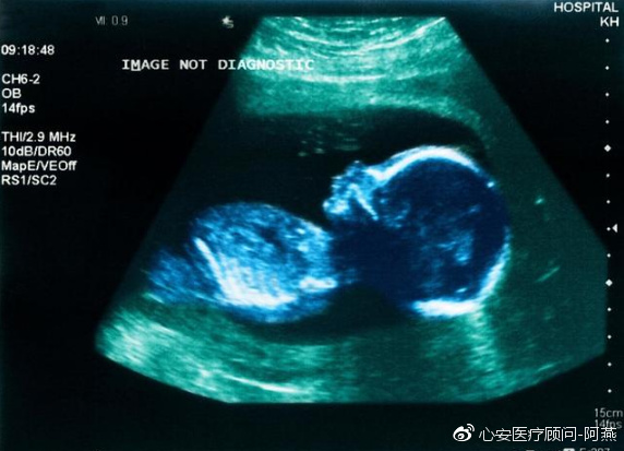 供卵试管婴儿nt检查出10mm-怀孕10周nt检查是什么？