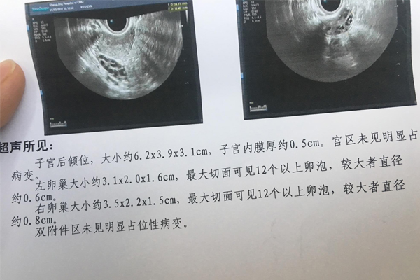 只有一个卵巢能做借卵试管婴儿成功吗？